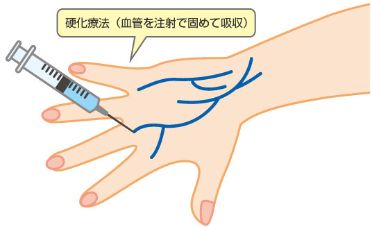 硬化療法